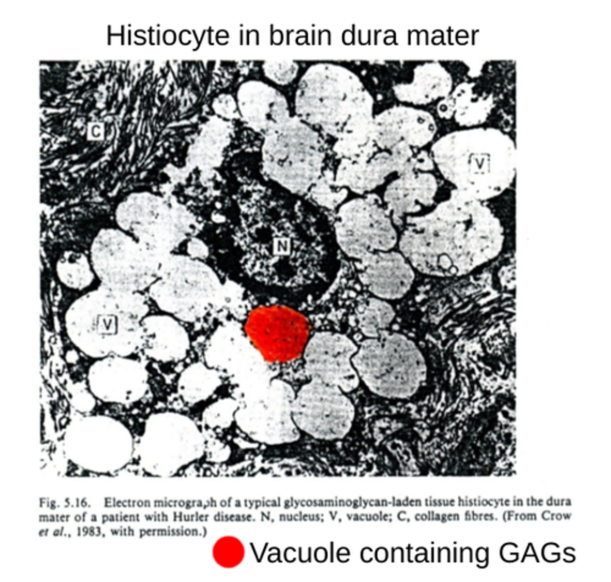 <p>histiocyte is a type of phagocyte derived from bone marrow that invades other tissues.</p><p>-Note the engorgement of GAGs in the vacuoles of the cell (colored red).</p>