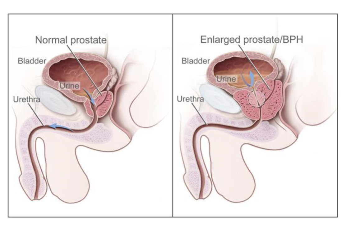 <ol><li><p>bladder irritation</p></li><li><p>obstruction/urinary retention</p></li><li><p>incomplete emptying → overflow incontinence</p></li></ol><p></p>