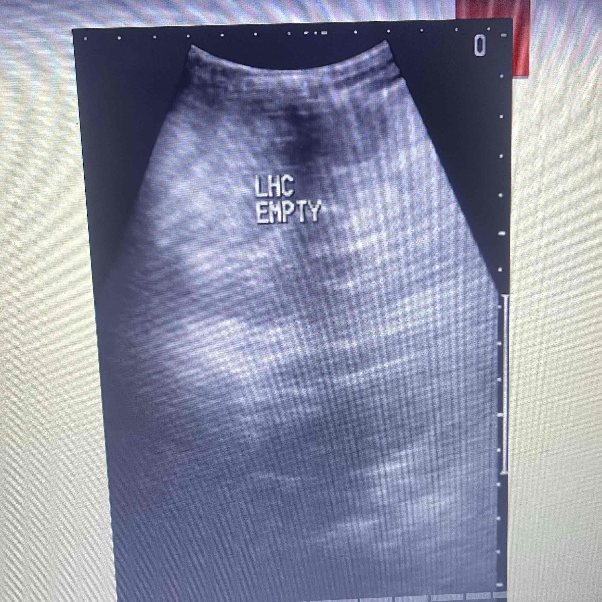 <ul><li><p>AKA asplenia</p></li><li><p>Complete embryologic absence of spleen</p></li><li><p>Occurs with additional major congenital abnormalities</p></li><li><p>Rare, benign</p></li><li><p>Clinically: Increased risk of infectious disease</p></li><li><p>Sonographic: No splenic tissue visualized in LUQ or abdominal/pelvic region</p></li></ul>