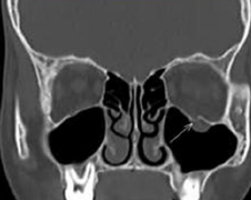 Why does enophthalmos occur from a blow-out fracture?