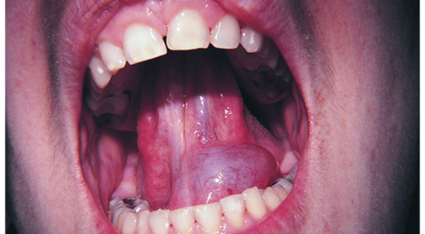 <p>Unilateral mucocele-like lesion that forms on the floor of the mouth; Associated with the ducts of submandibular & sublingual glands</p>