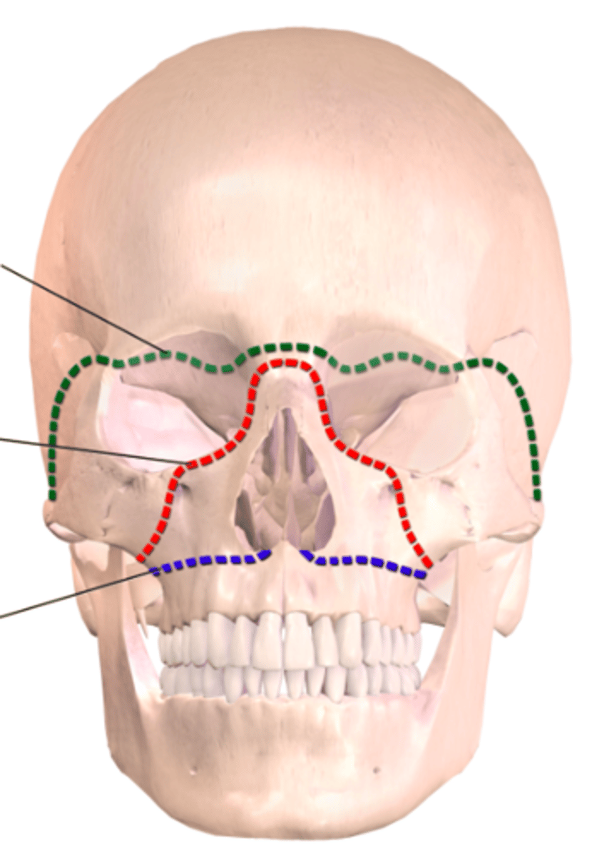 <p>ID the fracture indicated by the blue line:</p>