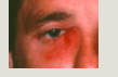 <p>darcycystitis</p>