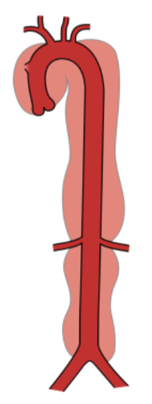 <p>begins at root of AO and may extend entire length of arch, ascending, and descending AO</p>