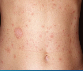 <p><strong>Pityriasis Rosea</strong></p><p>-Etiology → viral</p><p>-Epidemiology → peak incidence in adolescence </p><p>-Symptoms </p><ul><li><p>______ patch → solitary, 2-5 cm, pink, oval patch with central _________ usually on the trunk or proximal ______</p></li><li><p>Generalized rash → follows herald patch in 1-2 weeks, occurs on ______ and proximal extremities, 0.5-2 cm _____ to oblong ________ that are red or tan with fine scale </p></li><li><p>“__________ ______ pattern”</p></li></ul><p>-Treatment → benign, self limited </p><p></p>