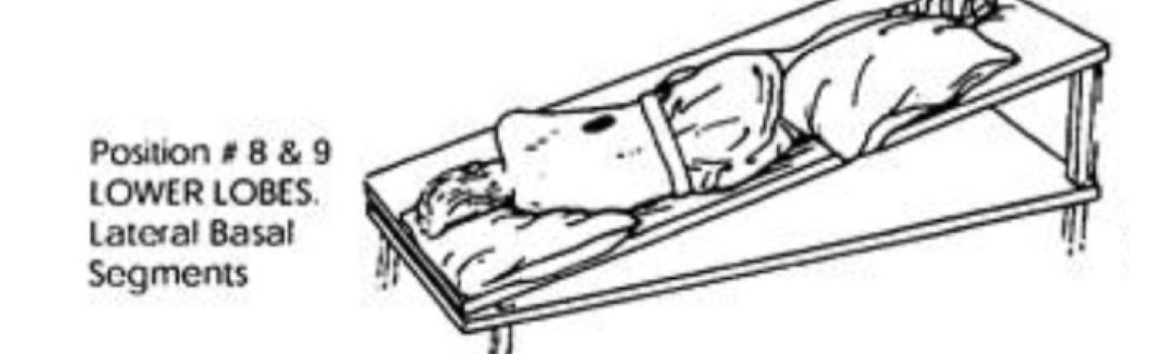 <ul><li><p>R or L Side Lying</p></li><li><p>Head Down 30 deg</p></li><li><p>¼ Turn Forward</p></li></ul><p></p>