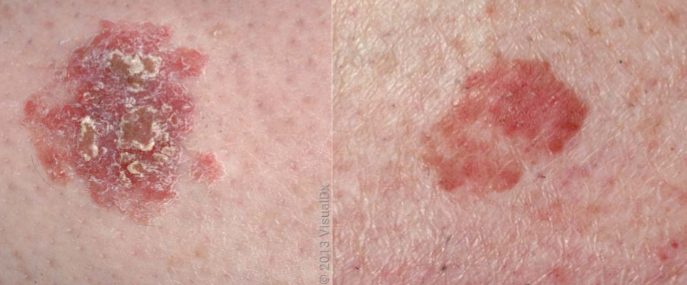 <p>squamous cell carcinoma in-situ appearance characteristics </p>