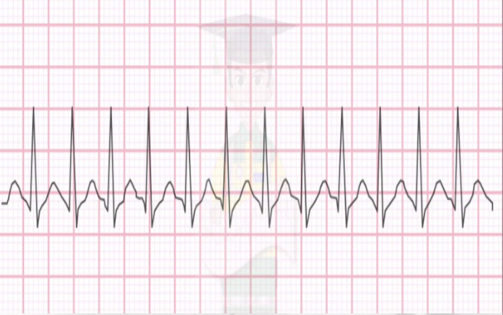 <p>Supraventricular Tachycardia (SVT)</p>