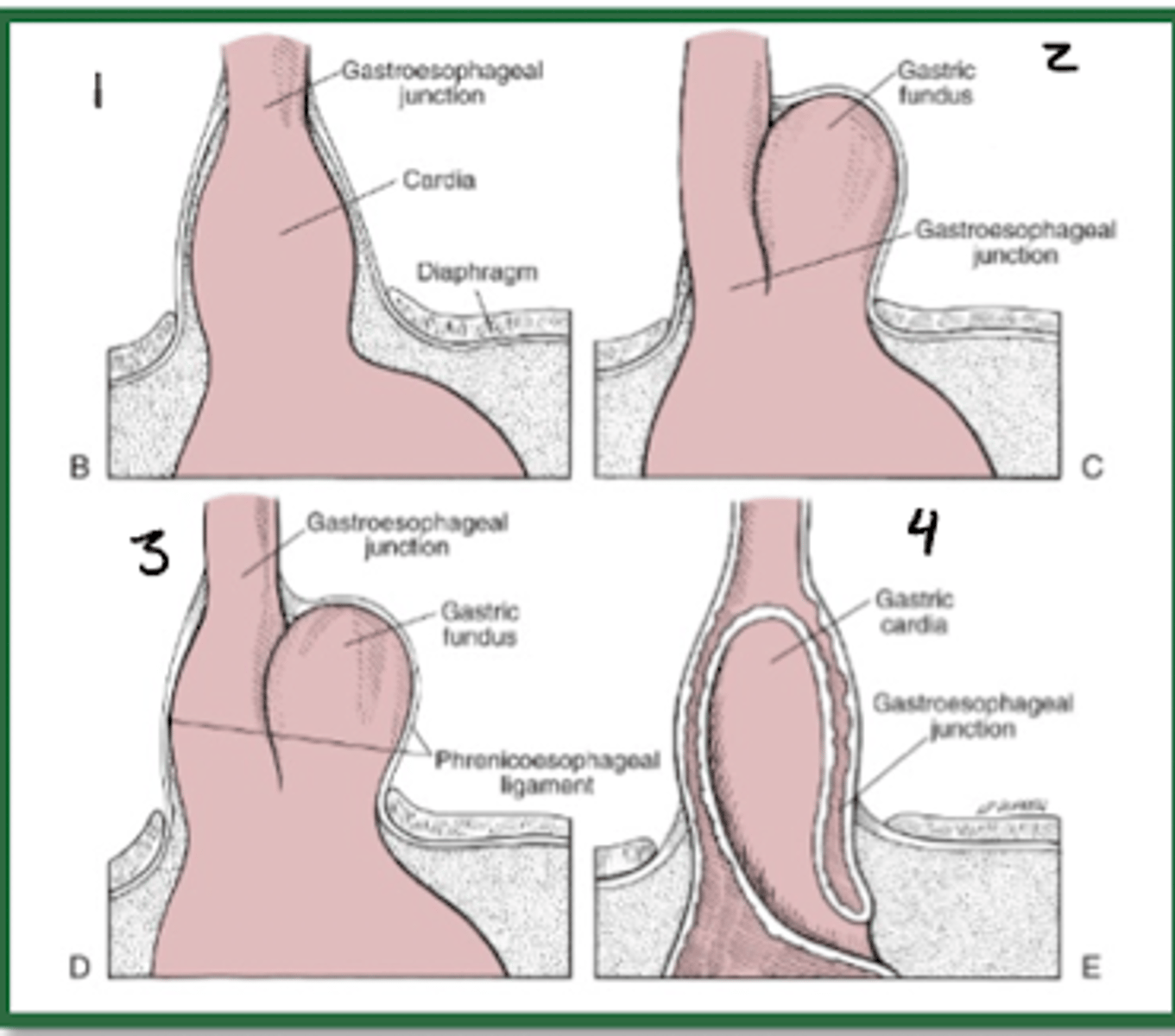 <p>•Type I = sliding hiatal hernia</p><p>•Types II, III and IV are all subtypes of paraesophageal hernias</p>