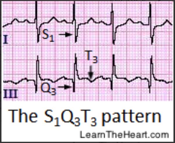 Non-specific ST and T wave abnormalities

\
Sinus tachycardia

\
New AF

\
Right axis deviation

\
RBB

\
S1Q3T3 (large S wave in lead I, Q wave in III, inverted T in III- classic cor pulmonale presentation)