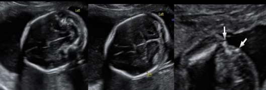 <p><strong>splaying</strong> of <strong>lateral spinous process</strong> + <strong>abn cerebellum </strong>indicates</p><p>a) holoprosencephaly</p><p>b) spina bifida</p><p>c) ellis van creveld syndrome</p><p>d) thanatophoric dysplasia</p>