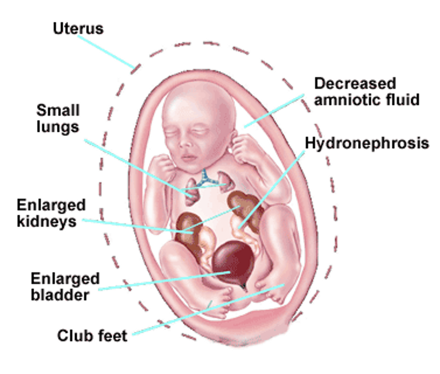 <p>Oligohydramnios is a serious condition that occurs when there is too little amniotic fluid during pregnancy:</p><p>What is it? Amniotic fluid is the watery substance that surrounds and protects a developing fetus in the uterus. Oligohydramnios occurs when the amount of amniotic fluid is less than expected for the baby's gestational age.</p>