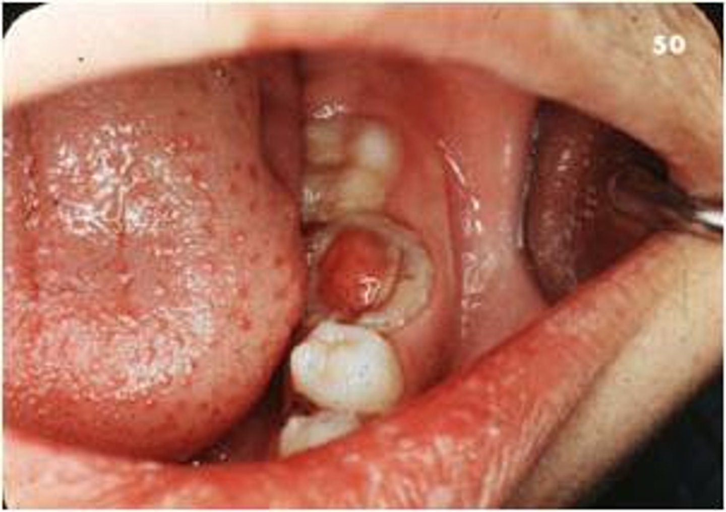 <p>caries</p>