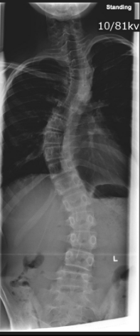 <p>Idiopathic.</p>
