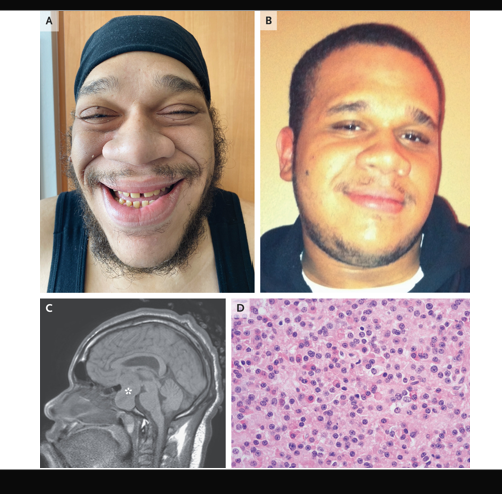 <ul><li><p>The physical changes and the bitemporal hemianopsia are consistent with excess growth hormone (acromegaly).</p></li><li><p>The MRI of Sam’s brain revealed a macroademona in the pituitary gland that compressed the optic nerve.</p></li></ul><p></p>