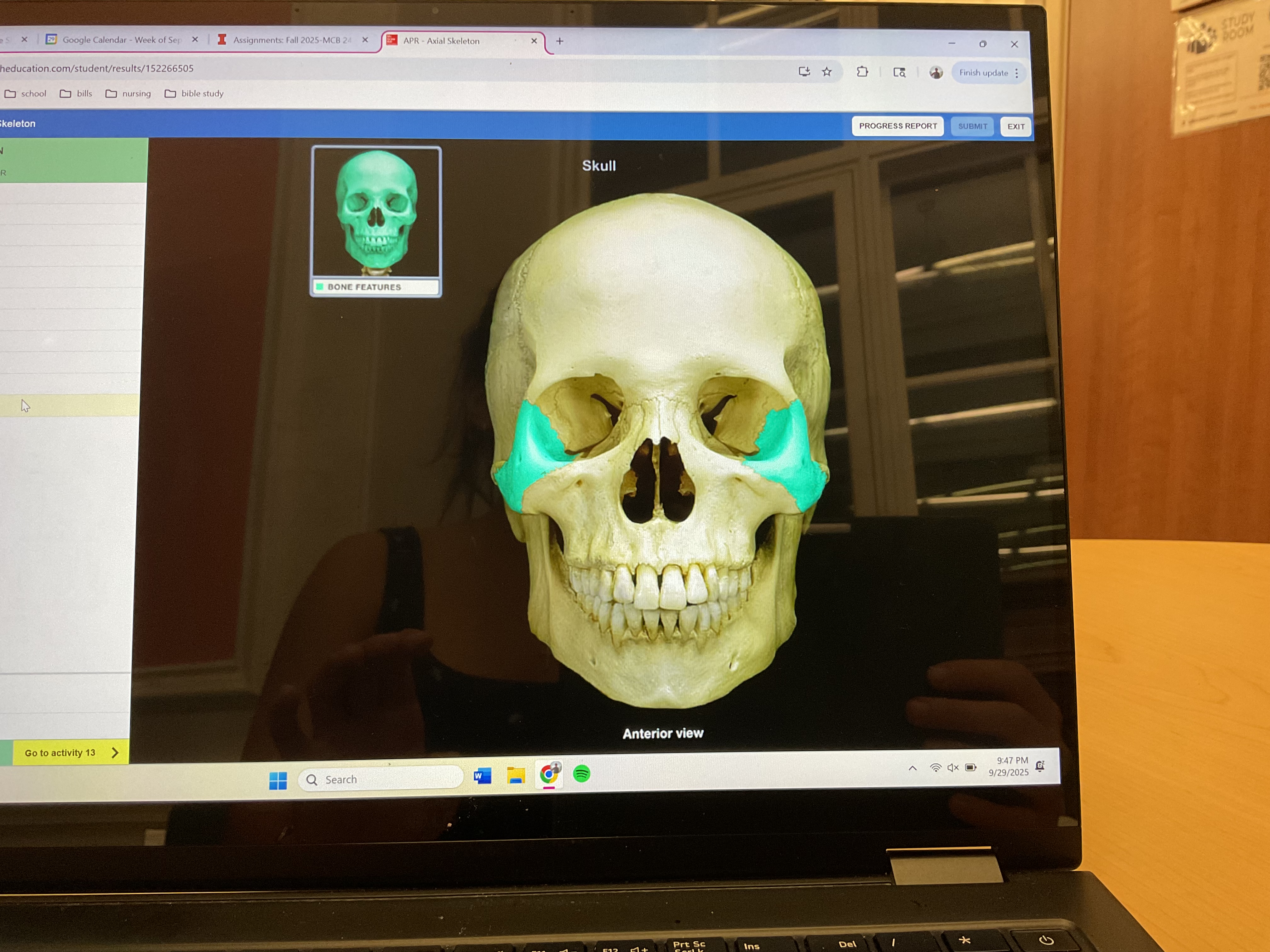 <p>Zygomatic bone </p>