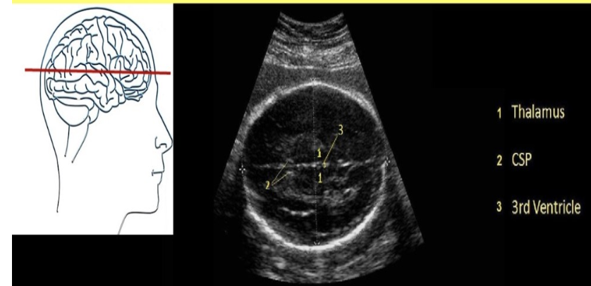 <p>a) Transverse axial view of the fetal skull at the level of the cavum septum pellucidum, third ventricle, and thalamus</p>