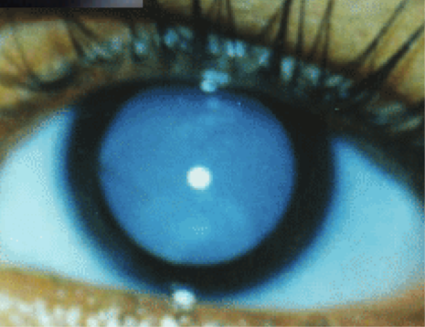 <ul><li><p><span><span>More commonly found in developing countries</span></span></p></li><li><p><span><span>entire lens being opaque = VA significantly affected</span></span></p></li><li><p>commonly assoc. with nystagmus</p></li></ul><p></p>