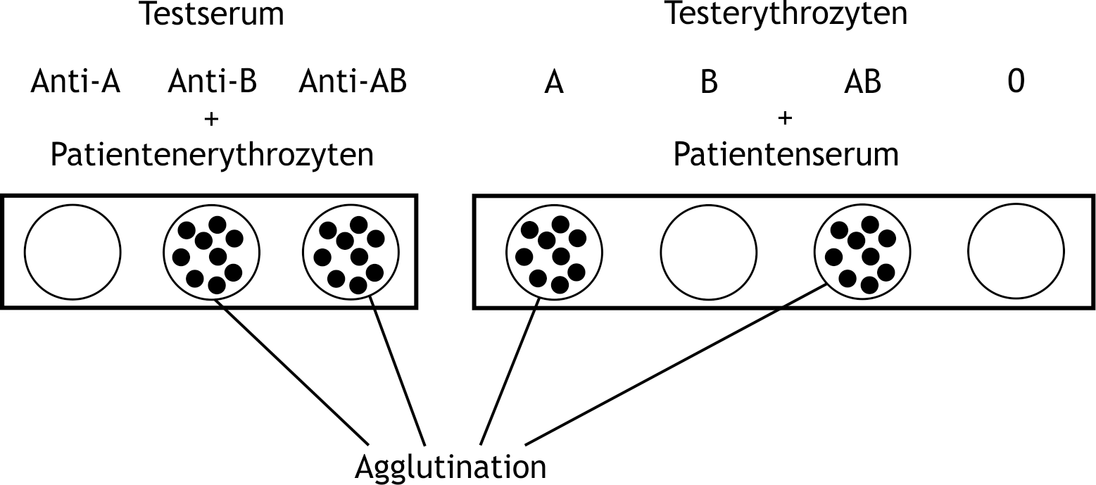 <p>6. The blood group determination of a patient with respect to the ABO system shows the following findings:</p><p>Which conclusion from this test result is correct?</p><p>A. The patient has blood group O.</p><p>B. The patient has blood group A.</p><p>C. The patient has blood group AB.</p><p>D. The patient has blood group B.</p><p>E. The findings of the blood group determination are contradictory.</p>