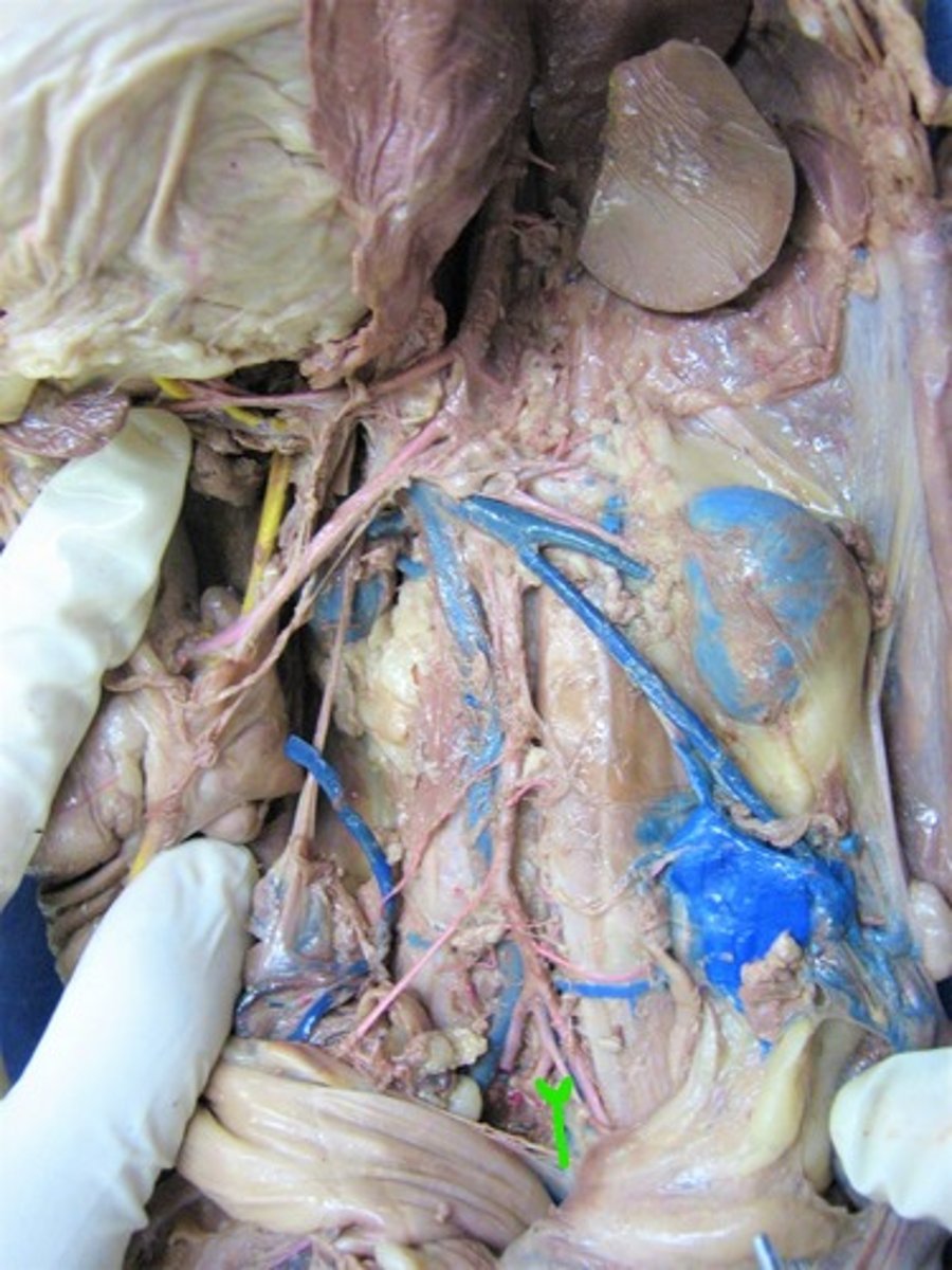 <p>identify this artery</p>