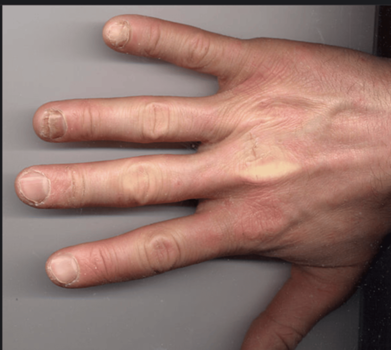 <p>- Nailbed pitting: superficial depressions in the nailbed</p><p>- Onycholysis: separation of nail plate from nailbed</p><p>- Subungual hyperkeratosis: thickening of the nailbed</p>