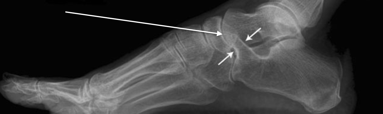 <p>What does this “anteater” sign indicate?</p>