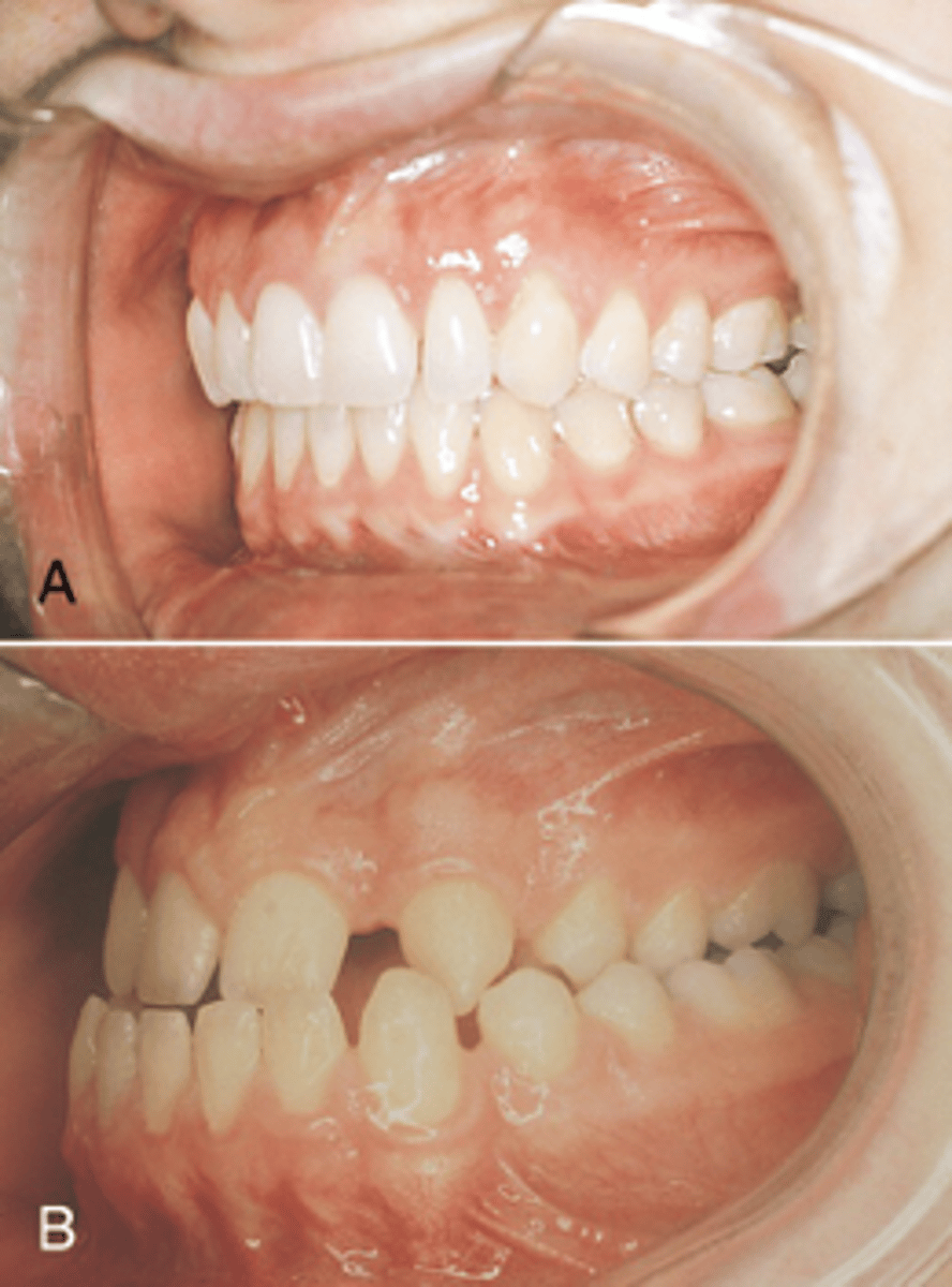<p>Malocclusion treatment</p>