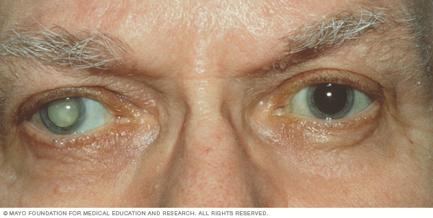 increased opacity of the lens, which blocks light rays from entering the eye. Cataracts develop slowly and progressively after age 35 or suddenly after trauma. 