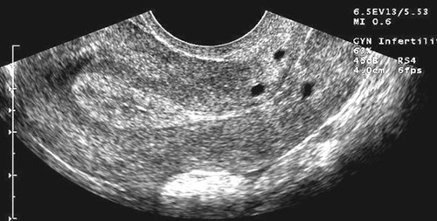 <p>Benign cysts in cervix</p><p>Made from Nabothian secretions</p><p>Asymptomatic</p>
