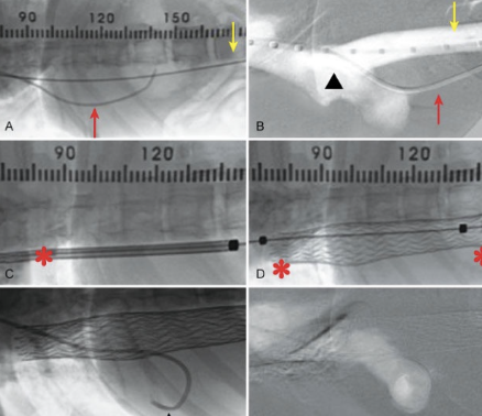 <p>- Minimally invasive with intravascular stents and coils (challenging, left easiest to surgically correct)</p>