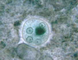 <p>(Tổng hợp 11) Đơn bào dưới đây (hình) có kích thước 10–16 μm, vách dày. Anh/Chị hãy định danh ký sinh trùng này.</p>
<p>A. E. coli, hoạt động<br />
B. E. coli, bào nang<br />
C. E. histolytica, hoạt động<br />
D. E. histolytica, bào nang</p>