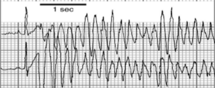 <p>What type of arrhythmia is this? </p>