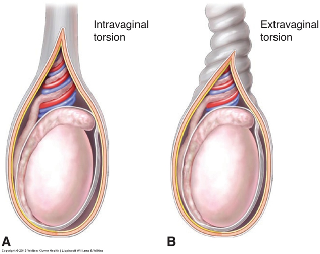 <p>Describe the two types of torsions? </p>