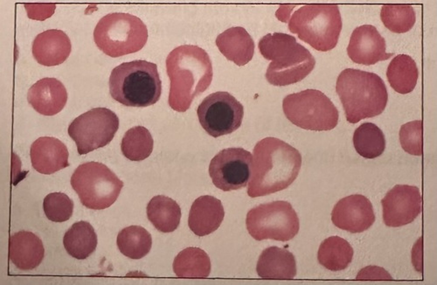 <p>The image of the blood smear from a newborn most likely represents:</p><p>a. severe G6PD deficiency</p><p>b. hereditary spherocytosis</p><p>c. untreated megaloblastic anemia</p><p>d. HDN due to ABO incompatibility</p>