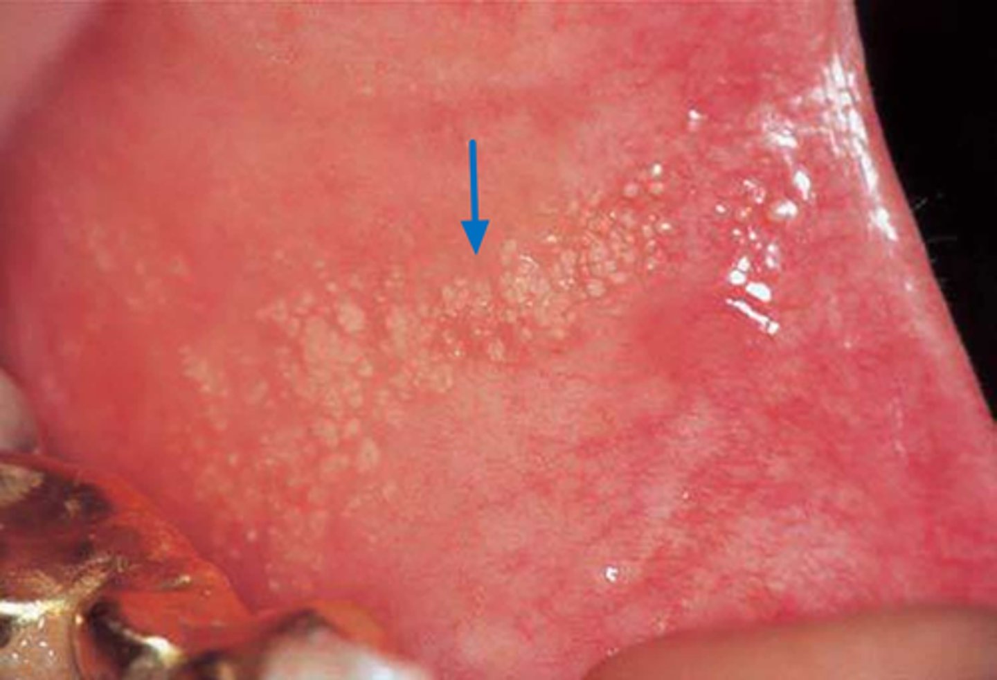 <p>• Sebaceous glands that occur on the oral mucosa</p><p>• Sebaceous glands are considered to be dermal adnexal structure so</p><p>those found in the oral cavity have been considered to be "ectopic"</p><p>• However, Fordyce granules have been reported in more than 80% of</p><p>the population</p><p>• SO THEY ARE NORMAL</p>