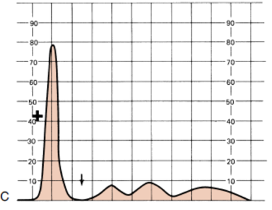 <p>Determine the condition of the patient given the serum electrophoresis graph</p><img src="https://knowt-user-attachments.s3.amazonaws.com/4e23d7b3-7d30-4a55-a165-2c4236b227d8.png" alt="knowt flashcard image"><p>A. Monoclonal gammopathy</p><p>B. Liver Cirrhosis</p><p>C. Nephrotic Syndrome</p><p>D. α1 –antitrypsin deficiency</p><p>E. NOTA</p>