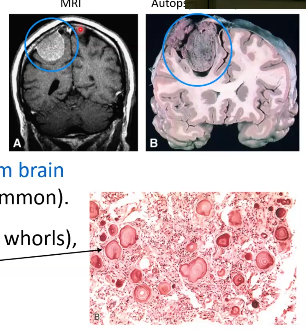<ul><li><p>Meningioma: GRADE I</p><ul><li><p>Tumor of adults but more females</p></li><li><p>Dural-based tumor and does not involve brain, brain invasion uncommon</p></li><li><p>Tumor cells have Psammoma bodies form spirals</p></li></ul></li></ul><p></p>