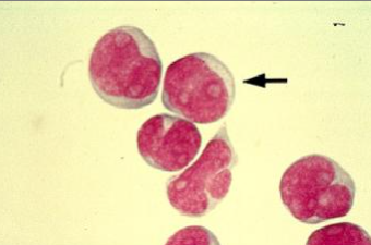 <p>CSF stained smear shows cells that may indicate what condition?</p><p>Allergic reaction<br>Bacterial meningitis<br>Leukemia with CNS involvement<br>Viral meningitis</p>