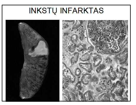 <p>Koaguliacinė nekrozė</p><p>centrinė dalis - anemiška, o periferinė ir apimanti smegeninį sluoksnį - hiperemiška ir hemoragiška</p>