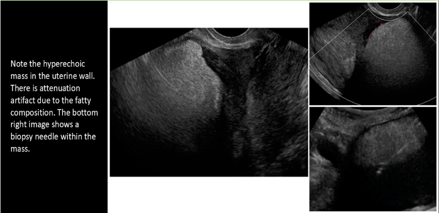 <p>a lipoleiomyoma will be hyperechoic to the myometrium due to increased levels of </p><p>a) striated muscle tissues</p><p>b) fatty tissue</p><p>c) connective tissue</p><p>d) ectodermal tissue</p>