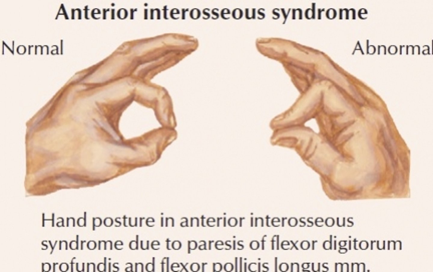 <p>weakness of flexor pollicus longus and flexor digitorum profundus to index finger</p><p>weakness of pronator quaradus</p><p>median nerve branch</p>