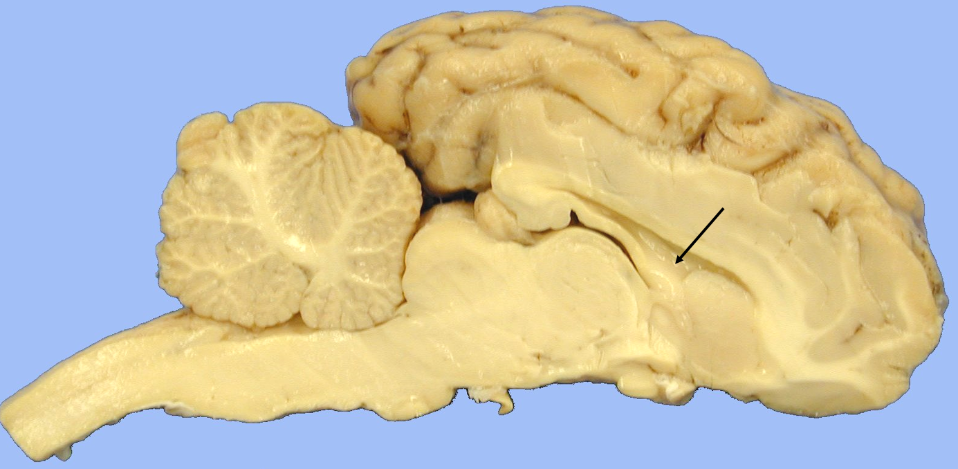 <p>septum pellucidum</p>