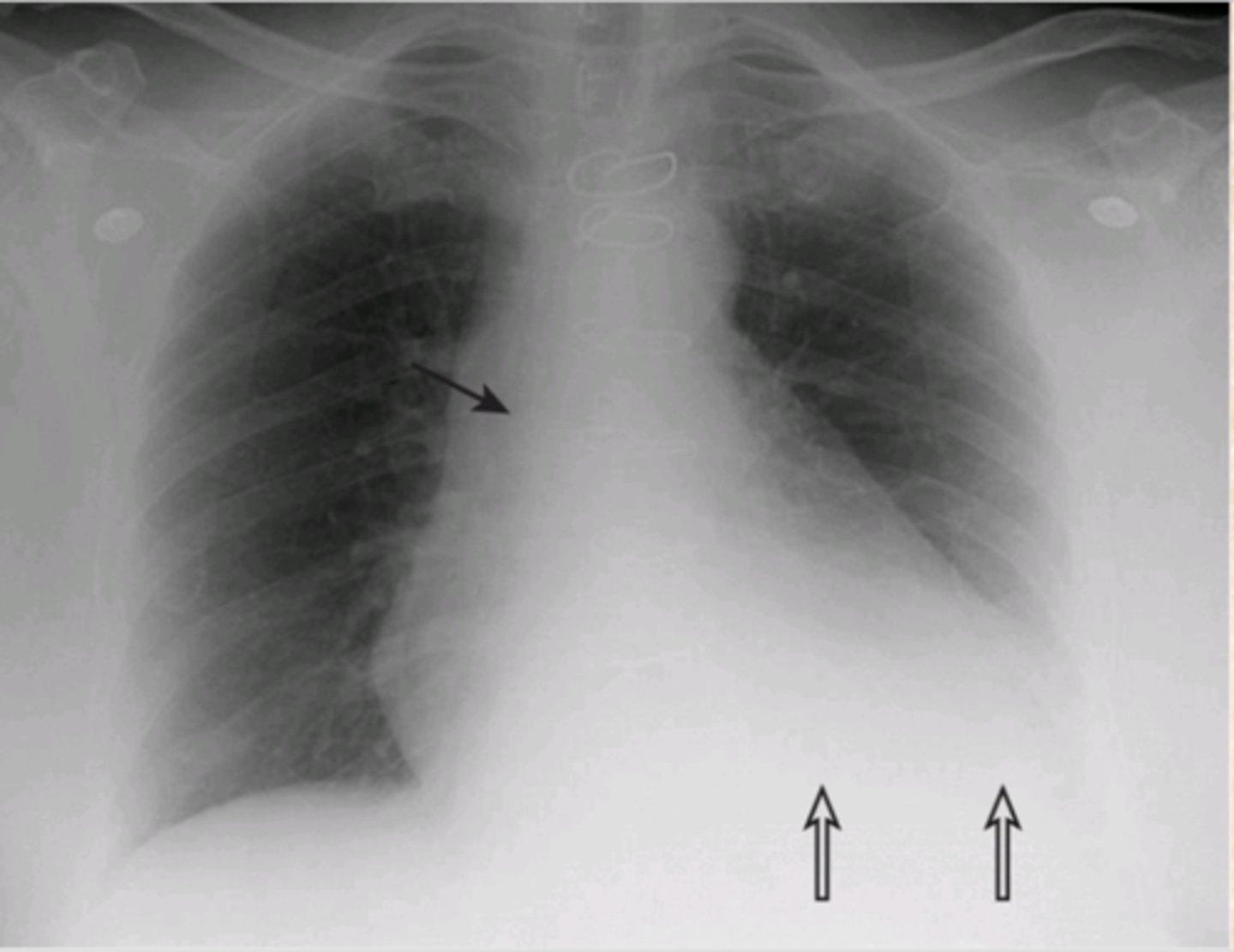<p>What is wrong with this CXR?</p>