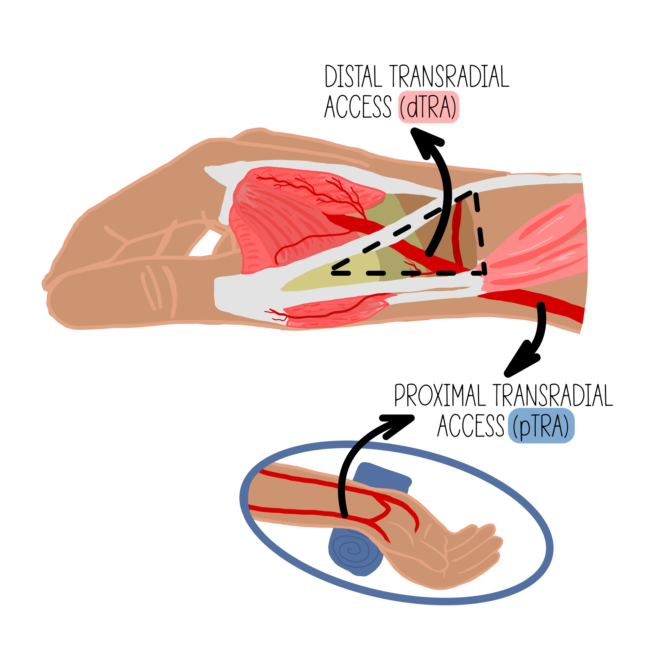 <p>What are some advantages of dTRA over TRA?</p><p><br></p>