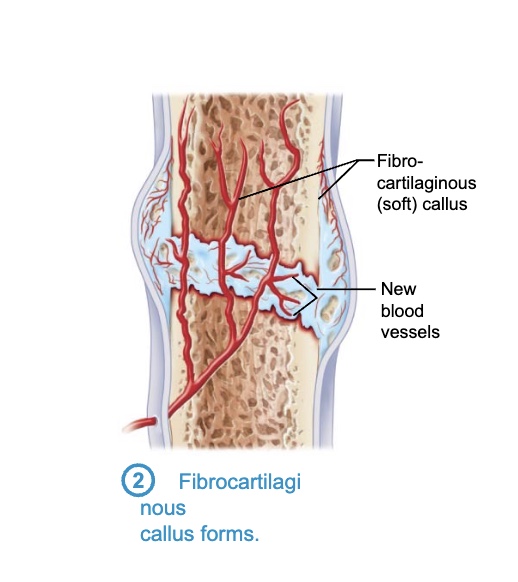 <p>– Capillaries grow into hematoma</p><p>– Phagocytic cells clear debris</p><p>– Fibroblasts secrete collagen fibers to span break and connect broken ends</p><p>– Fibroblasts, cartilage, and osteogenic cells begin reconstruction of bone</p><p> Create cartilage matrix of repair tissue</p><p> Osteoblasts form spongy bone within matrix</p><p>– This mass of repair tissue is called fibrocartilaginous callus</p>