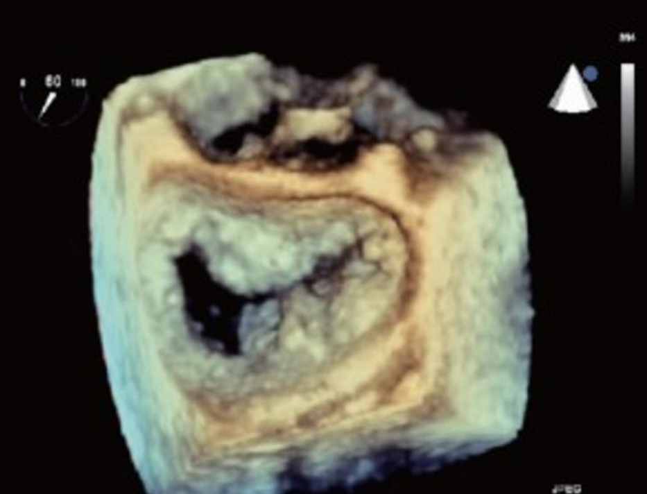 <p>3D of the MV demonstrating? </p>