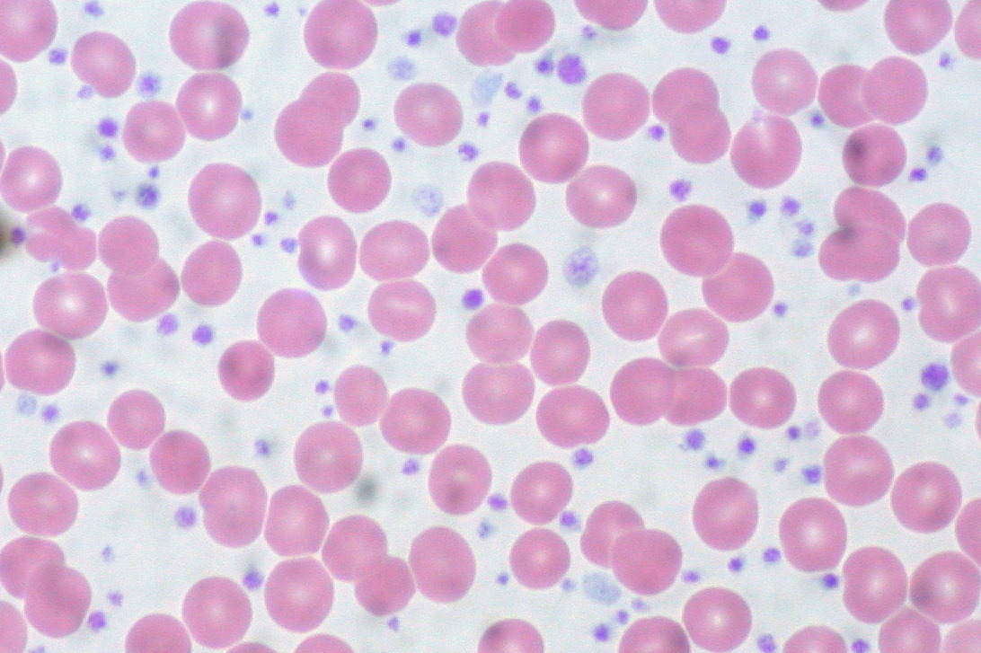 <p>• PLT &gt;600K, often &gt;1 million<br>• Bone marrow: ↑ megakaryocytes<br>• Peripheral smear: giant, bizarre, and small platelets; large aggregates<br>• Spontaneous aggregation<br>• Platelet dysfunction → ↑ risk of thrombosis and bleeding</p><p></p>