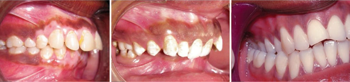 <p><strong>Prognathism</strong>- forward placement of the jaw</p><p><strong>Retrognathism</strong>- backward placement</p><p>Both can occur</p>