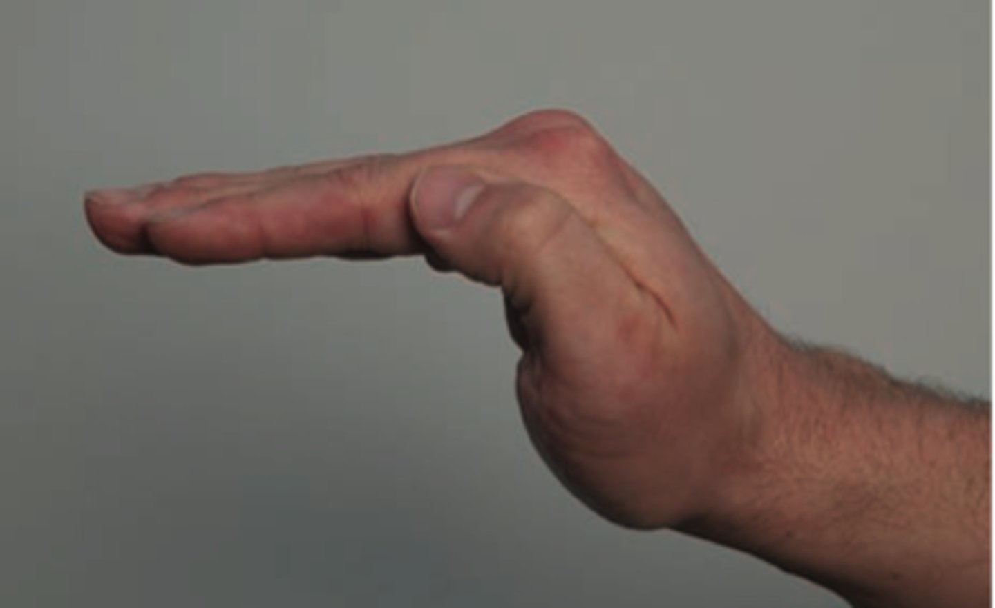 <p>metacarpophalangeal</p>