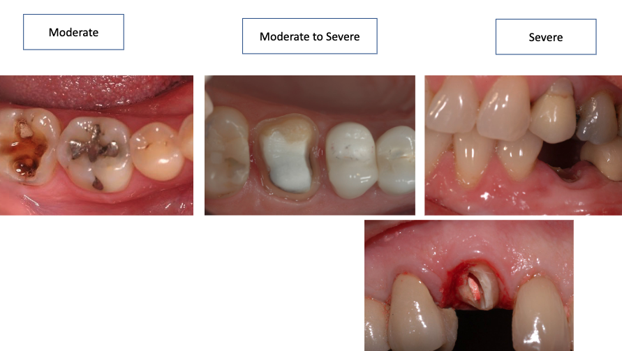 <ul><li><p>loss of part of tooth structure</p></li><li><p>cracked tooth syndrome</p></li><li><p>missing tooth (1-3)</p></li></ul><p></p>